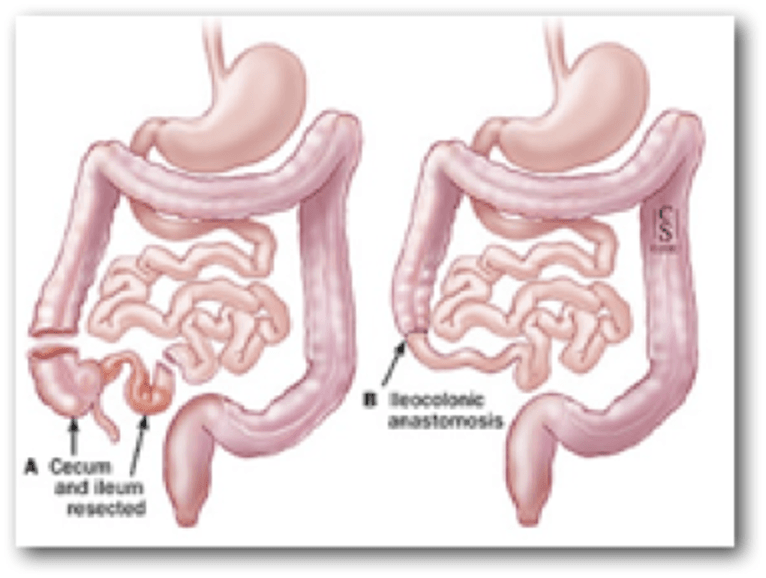 CROHN Φωτό 3: Εκτομή τελικού ειλεού και τυφλού