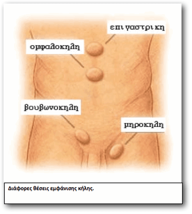  Κήλη ανατομία