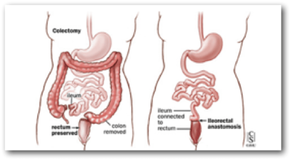 CROHN Φωτό 4: Ειλεοορθική αναστόμωση