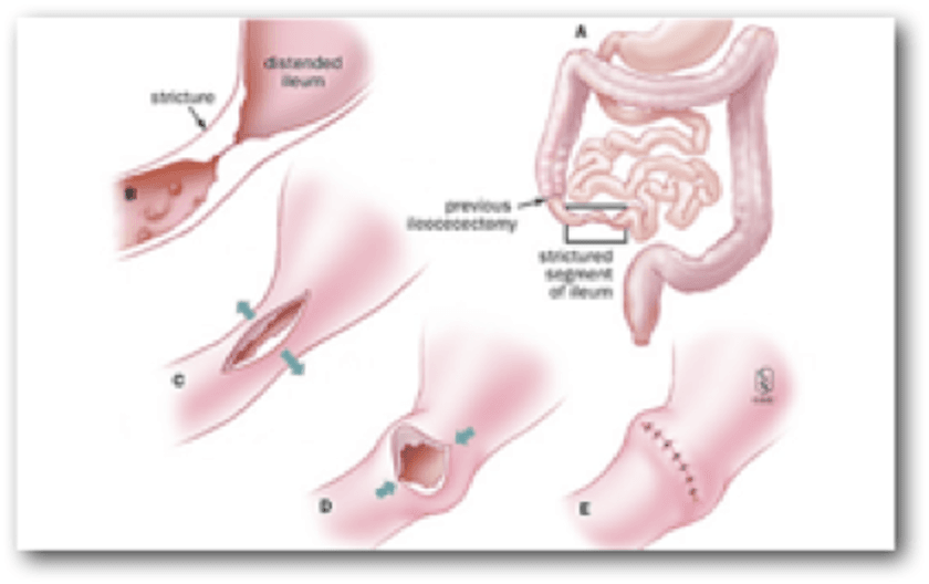 CROHN Φωτό 2: Στενωπλαστική