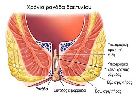 Χρόνια ραγάδα