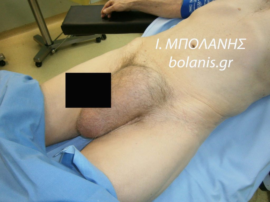 βουβωνοκήλη